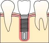 歯肉を切開し、インプラントの上層部を出す。